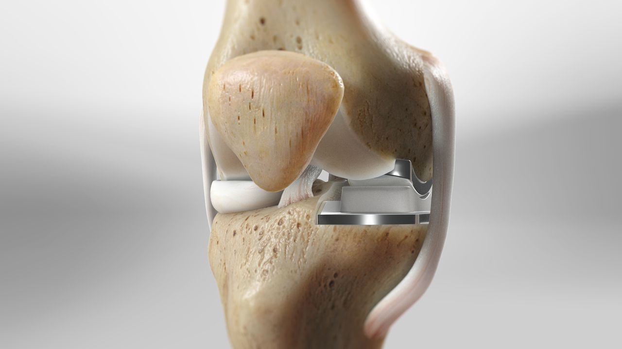 implantes articulares
